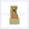 PNT-0540 Krankheit Zahnmodell
